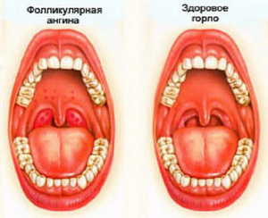 Фоликулярная ангина Фоликулярная ангина в горле