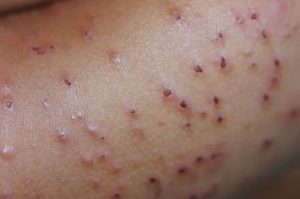 Какие существуют формы стрептодермии Описание форм стрептодермии