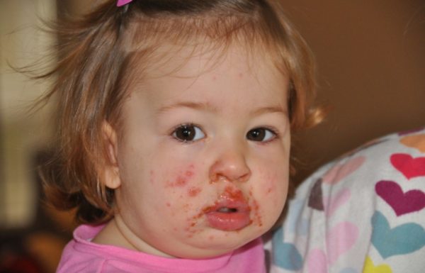 Профилактика Коксаки у детей и взрослых 2