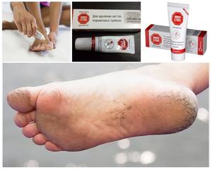 Грибок стопы: симптомы, эффективные дешевые препараты для лечения, профилактика 2