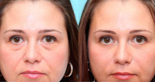 Как убрать синяки под глазами: косметические процедуры от мешков и синяков под глазами