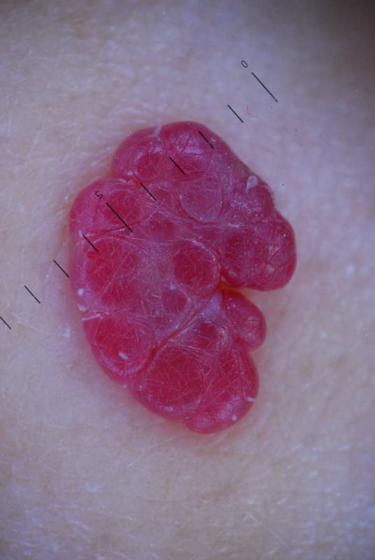 Родинка под правым глазом у женщин: что значит, причины появления, лучший способ удалить новообразование на веке2