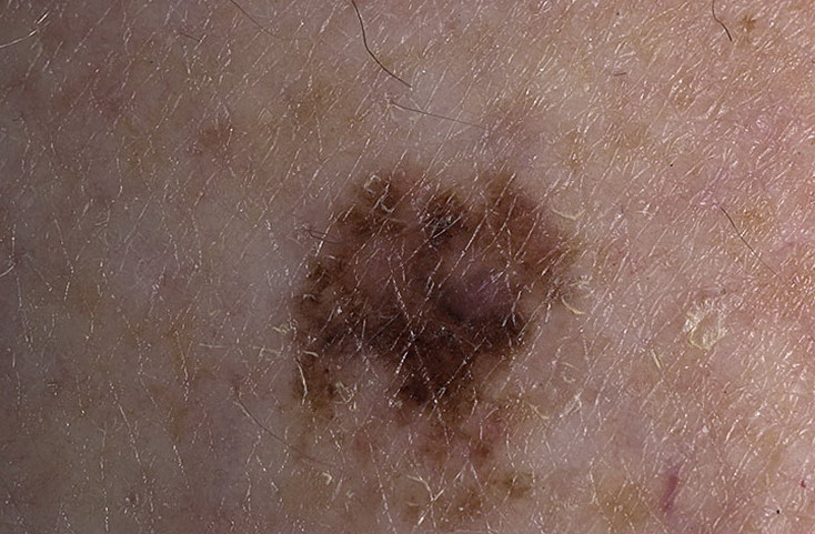 можно выдергивать волосы из родинки