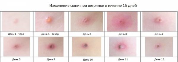 Ацикловир при ветрянке у детей и взрослых: инструкция по применению 2