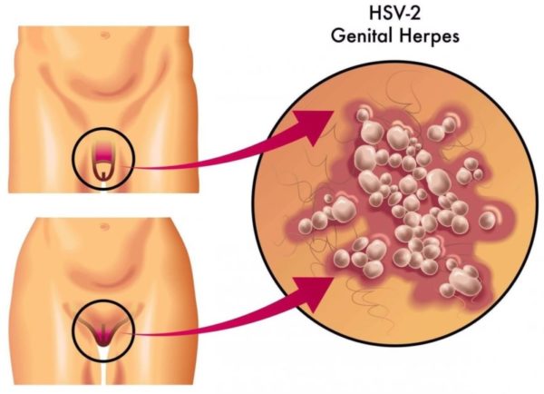 Генитальный герпес при беременности: лечение и профилактика 1