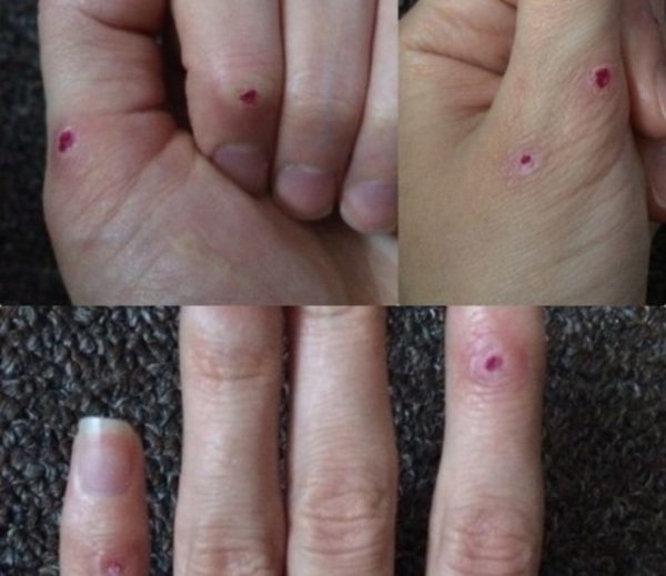 Удаление папиллом жидким азотом 7