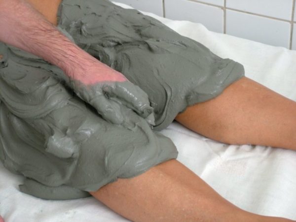 Лечение трофических язв голени при варикозном расширении вен 5