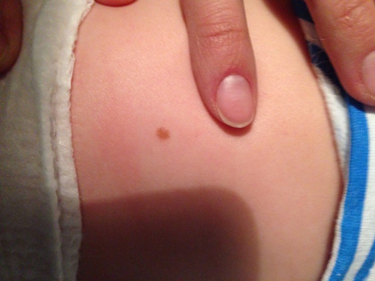 Когда у малышей появляются родинки: причины появления многих невусов и какие из них опасны для малыша