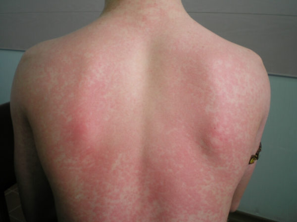 Аллергический дерматит: причины развития, симптомы, диагностика, терапия 1