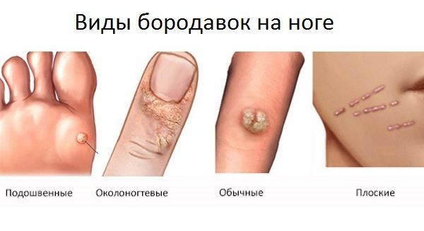 Бородавка на пальце ноги: как она выглядит и какие методы лечения существуют