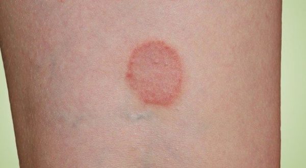 Зуд внутренней поверхности бедра у женщин: причина события, к какому врачу обратиться 2