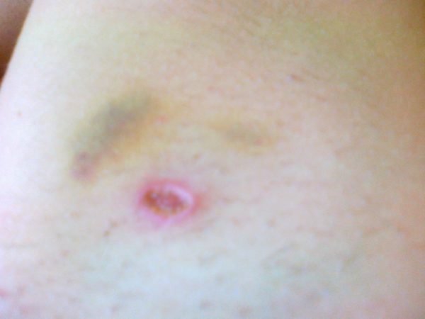 Упала крот: причины, первая помощь, методы лечения