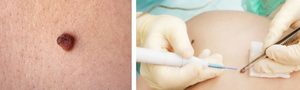 Как опознать опасную родинку Как обезопасить себя от сдирания родинки