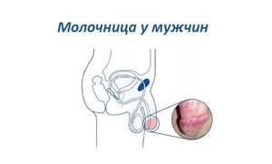 Как проявляется заболевание у мужчины Проявление заболевания