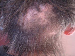 Виды и признаки лишая у человека Виды и признаки лишая