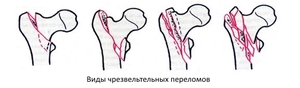 Чрезвертельный перелом бедра Чрезвертельный перелом - что это такое