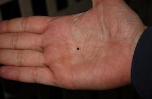 Форма, цвет и размер родинки на ладони Что означает родинка на правой ладони