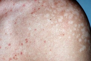 Профилактика рецидива Какие есть препараты для лечения лишая