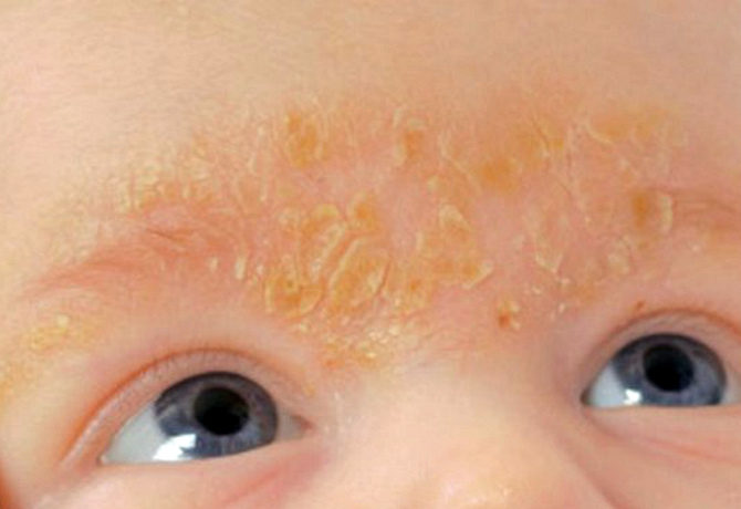 Себорейный дерматит у грудничков: чем может быть вызвано заболевание, как избавиться от перхоти