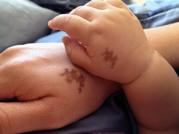 Невус: что это такое, причины образования, виды, симптомы возрождения 2