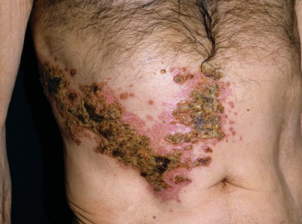 Невралгия после герпеса: лечение обезболивающими 1