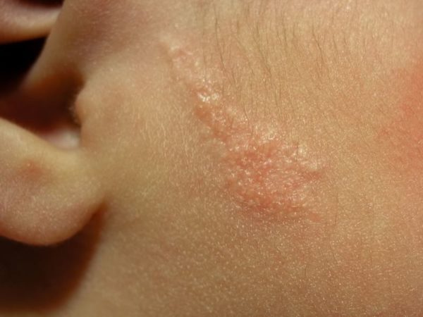 Виды родинок у человека: доброкачественные и злокачественные 6