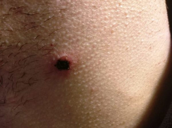 Упал крот: причины, первая помощь, методы лечения6