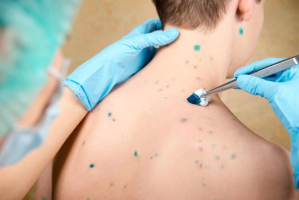 Как отличить ветрянку от энтеровируса 3