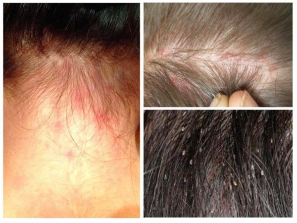 Как распознать вшей, как отличить гниды от перхоти 1