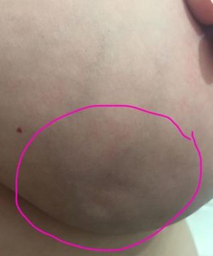 Признаки рака Признаки рака молочной железы