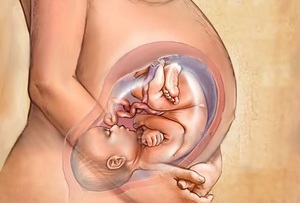 Профилактика обвития пуповиной Как исправить патологию