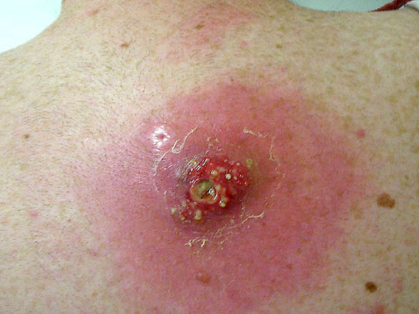 Как извлечь гной из фурункула в домашних условиях