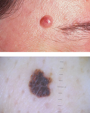 Классификация папилломатозного невуса Виды папилломатозных родинок