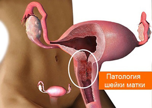 Хирургическое вмешательство Как лечить дисплазию матки