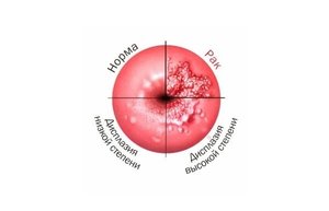Клиническая картина заболевания Симптомы дисплазии шейки матки