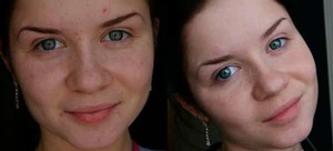 Эритромицин – крем для лечения кожных высыпаний, который является системным антибиотиком мазь от прыщей с антибиотиком