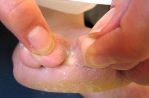 Грибок между пальцами: симптомы и признаки, лечение препаратами и народными средствами