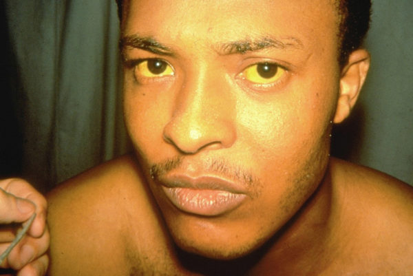 Зуд кожи тела при заболевании печени: причины, симптомы, лечение