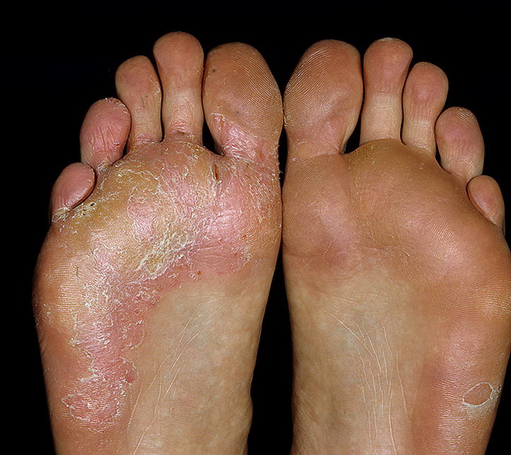 Кора дуба от потных ног: народные методы лечения гипергидроза в домашних условиях