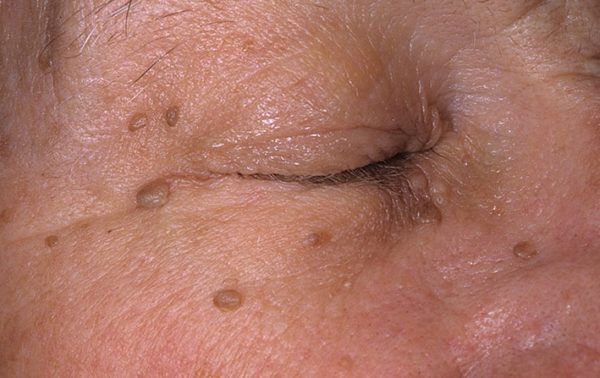 Виды родинок у человека: доброкачественные и злокачественные 14