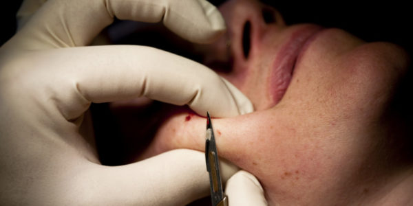 Невус: что это такое, причины образования, виды, симптомы возрождения 14