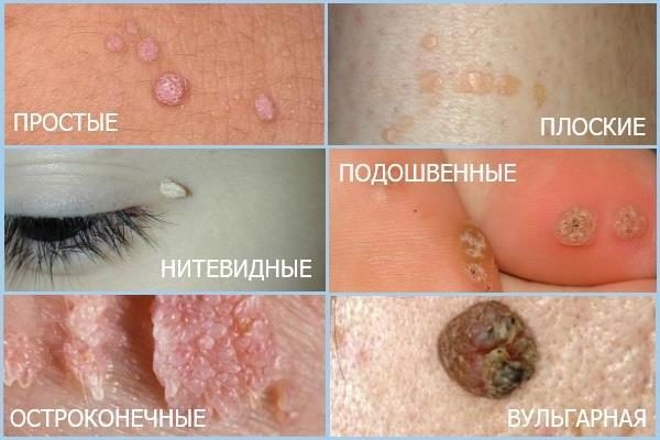 Бородавки заразны - они передаются от человека к человеку при прикосновении