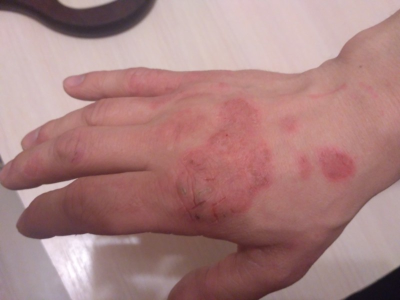 Пятна на коже похожи на лишай и не чешутся: что это может быть, какие заболевания похожи на лишай2