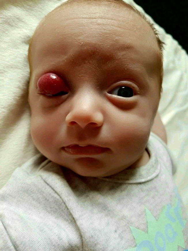 Гемангиома у новорожденных: что это такое, причины возникновения, каковы методы лечения