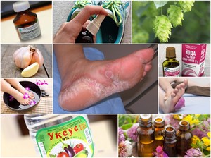 Способы избавления от грибка на ногах народными средствами: рецепты, помогающие в борьбе с недугом