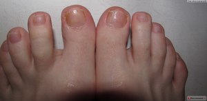 Симптомы грибка ногтей на ногах: первые признаки, особенности проявления различных форм болезни