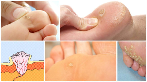 Подошвенная бородавка на ноге: как выглядит, удаление в домашних условиях 2