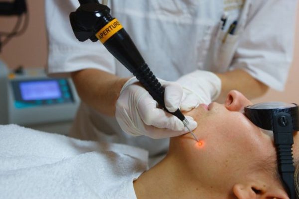 Висячие папилломы: причины появления и как их удалить в домашних условиях