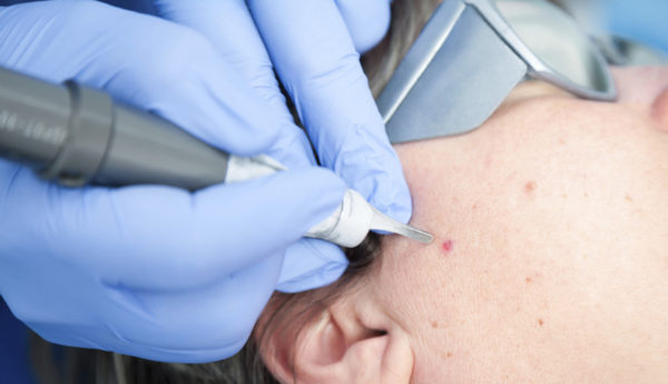 Родинки на лице: причины, методы лечения, влияние на судьбу и характер 6