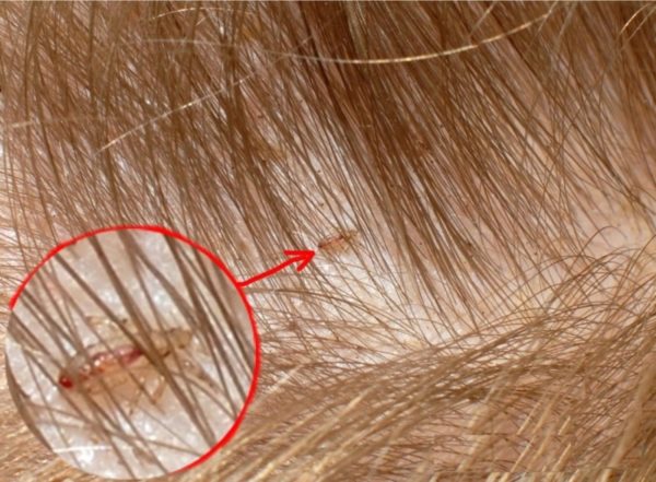 Откуда берутся вши на голове у ребенка